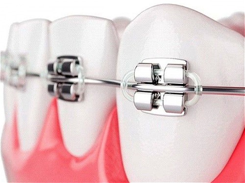 مراقبت های بعد از انجام ارتودنسی